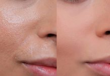 Geniş Gözenek Sorunuyla Mücadele: Bilmeniz Gerekenler Gözenek sorunu