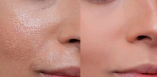 Geniş Gözenek Sorunuyla Mücadele: Bilmeniz Gerekenler Gözenek sorunu