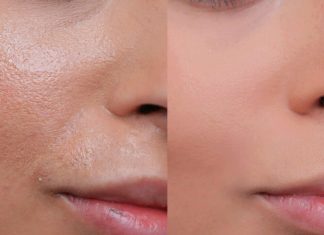 Geniş Gözenek Sorunuyla Mücadele: Bilmeniz Gerekenler Gözenek sorunu